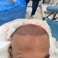 کاشت سر و ابرو|خدمات آرایشگری و زیبایی|بابل, |دیوار