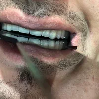 روکش های دندانی(پروتز های دندانی)|خدمات آرایشگری و زیبایی|ارومیه, |دیوار