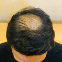 کاشت‌مو با تراکم بالا باضمانت کتبی۱۰ساله‌بدون ریزش|خدمات آرایشگری و زیبایی|کهنوج, |دیوار