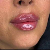 بوتاکس ۴۵۰ ژل ۸۵۰