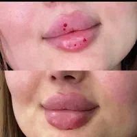 ژل(فیلر) بوتاکس مزوتراپی صورت رفع لک مزو مورشدمو