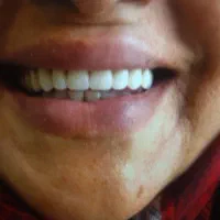 دندانسازی با متد جدید