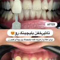 کامپوزیت لمینت بلچینگ روکش ایمپلنت ترمیم عصب کشی|خدمات آرایشگری و زیبایی|مشهد, فردوسی|دیوار