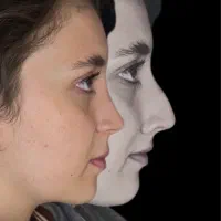 عمل جراحی بینی فقط ۲۸ میلیون/لیفت صورت/کرج و تهران