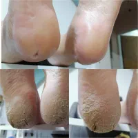 اموزش پدیکور پا .تخصص پدیکور پا درمانی.فیشیال