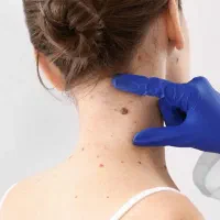 زگیل خال گوشتی و مخچه و...|خدمات آرایشگری و زیبایی|سرپل ذهاب, |دیوار
