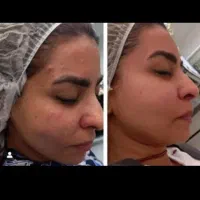 فیشال تخصصی، برداشت خال و ککو مک، ژل و بوتاکس|خدمات آرایشگری و زیبایی|شاهرود, |دیوار