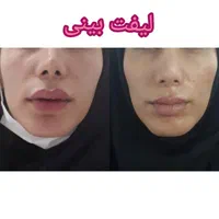 آفر تزریق بوتاکس ژل گونه چانه/فیلربینی زیرچشم/نخ|خدمات آرایشگری و زیبایی|تهران, فدک|دیوار