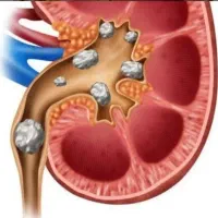 درمان سنگ کلیه