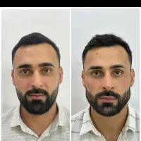 فیلروبوتاکس و چال لپ و‌مزو