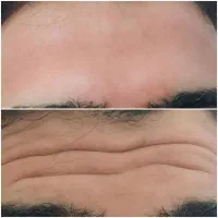 تخفیف ویژه‌ی خدمات ژل و بوتاکس بع مدت محدود|خدمات آرایشگری و زیبایی|ایذه, |دیوار