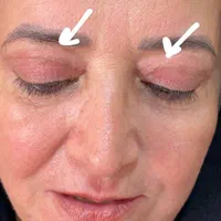 حذف پف پلک و افتادگی بوتاکس،ژل،بوکال،سانترال،هایفو|خدمات آرایشگری و زیبایی|تبریز, |دیوار
