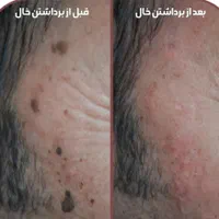 خال برداری و ضایعات پوستی در کلینیک معتبر|خدمات آرایشگری و زیبایی|کرمانشاه, |دیوار