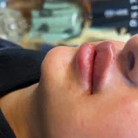 تزریق ژل با ماندگاری بالا