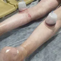 حجامت زالو فصد بادکش دیسک سیاتیک دررفتگی زردی ناف|خدمات آرایشگری و زیبایی|گنبد کاووس, |دیوار