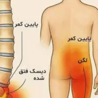 درمان‌۱۰۰درصدسیاتیک باروش TAHGSیاتاج سر