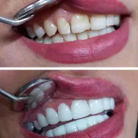 کامپوزیت زیبایی جشنواره ی تخفیفی یلدا