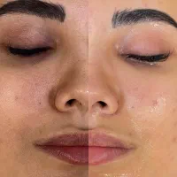 فیشیال تخصصی ویژه آقایان درکلینیک زیرنظرپزشک|خدمات آرایشگری و زیبایی|مشهد, صیاد شیرازی|دیوار