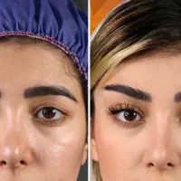جشنواره تابستانی بلفاروپلاستی لیفت ابرو سانترال
