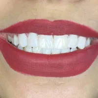 کامپوزیت در دندانپزشکی دکتر صادقیان
