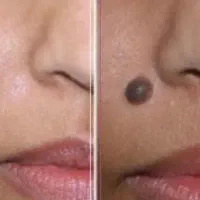 خالبرداری و ترمیم جای زخم و اسکار