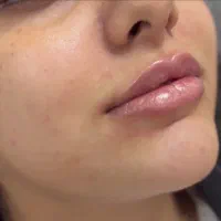 تزریق ژل لب تکنیک Mوبوتاکس