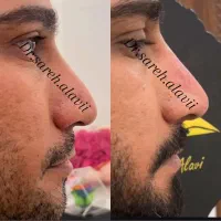 اصلاح فرم بینی بدون جراحی و بیهوشی توسط پزشک|خدمات آرایشگری و زیبایی|قم, دورشهر|دیوار