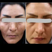 مشاور تخصص چهار ساله درمان پوست و مو افتادگی پلک