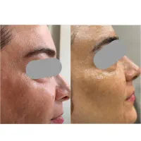 مزونیدلینگ صورت(جوان‌سازی،برطرف کردن جای جوش و لک)|خدمات آرایشگری و زیبایی|بابل, |دیوار