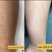 ژل وبوتاکس ولیزر وفشیال وخالبرداری ومزونیدلینگ|خدمات آرایشگری و زیبایی|تبریز, |دیوار
