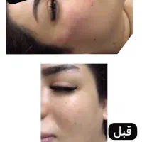 تزریق ژل با متد جدید