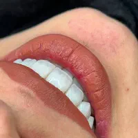 کامپوزیت ونیر و بلیچینگ (سفید کردن) دندان|خدمات آرایشگری و زیبایی|تاکستان, |دیوار