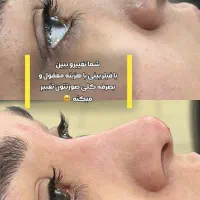 تزریق ژل لب /بوتاکس /فول فیس / هایفو /بلفاروپلاست