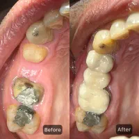 فرصت محدود پروتز و روکش دندان به قیمت ۱۴۰۴