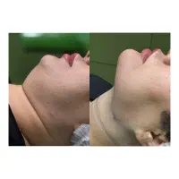 ساکشن غبغب،جراحی بلفاروپلاستی