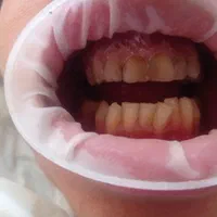 تخفیف فصلی کامپوزیت (1/500ت).عصب کشی در ایرانمهر|خدمات آرایشگری و زیبایی|یاسوج, |دیوار