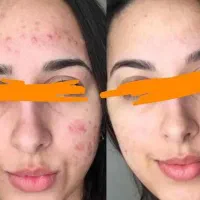 اگه قند داری چربی داری کلی مشکلات بیا|آرایشی، بهداشتی، درمانی|رشت, کوی حسینی|دیوار