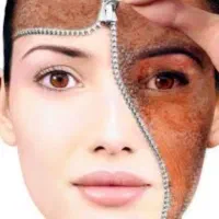 بوتاکس ،مزوتراپی ،پی ار پی ،میکرونیدلینگ