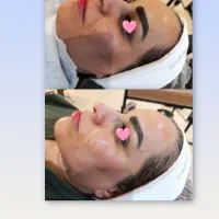 پاکسازی و فیشال تخصصی ، جوانسازی پوست