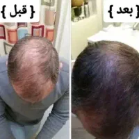 تونیک ضدریزش و رویش مجدد هیرفرند|آرایشی، بهداشتی، درمانی|تهران, نیروی هوایی (پیروزی)|دیوار