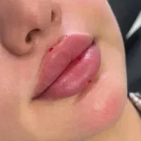 تزریق فیلر بادی ژل لب بوتاکس لاغری لیفت  کانتورینگ