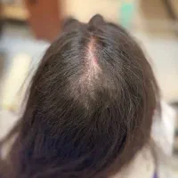 پی ار پی،پی ار اف،اگزوزوم.مزوتراپی،هیرفیلرPRPوPRF|خدمات زیبایی و سلامت|تهران, هفت حوض|دیوار