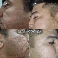 لیزر جای جوش و زخم.منافذ پوست|خدمات آرایشگری و زیبایی|نجف‌آباد, شریعتی غربی|دیوار
