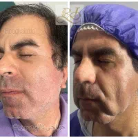 تخفیف و مشاوره جراحی زیبایی صورت و لیپو شکم|خدمات زیبایی و سلامت|تهران, ستارخان|دیوار