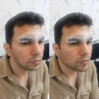 اموزش فیلر و بوتاکس پی ار پی .مزوتراپی