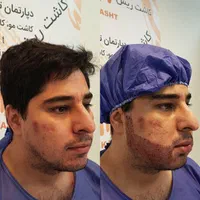 کاشت مو،کاشت ابرو،کاشت ریش با شرایط استثنایی|خدمات آرایشگری و زیبایی|تهران, دردشت|دیوار