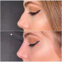 بوتاکس ژل لیفت نخ صورت بینی بلفاروپلاستی فیلر چرب