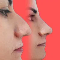 اصلاح قوز و افتادگی بینی با تزریق فیلر در مطب پزشک