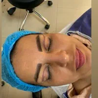 بلفاروپلاستی،لیفت ابرو،لیفت شقیقه،دایرکت ابرو