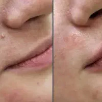 حذف تخصصی انواع خال،زگیل وچربی زیرپوست
